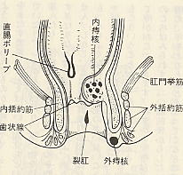 痔（ぢ）漢方薬、漢方相談の中屋